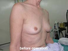 plastic-surgery-breast-augmentation 